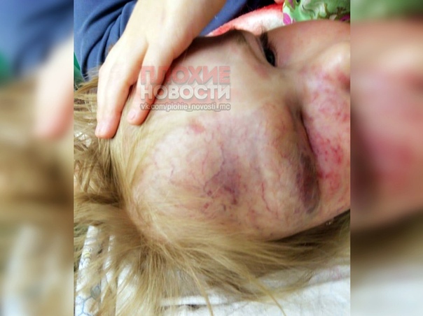 В закрытом уральском городе Новоуральске военнослужащая избила свою дочку за то, что та отказалась есть